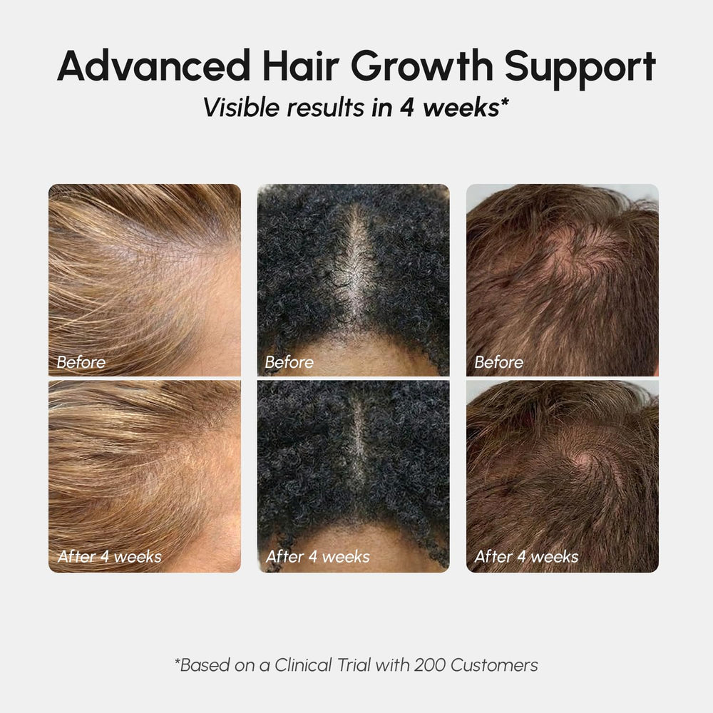Rosemary oil bottle highlighting scalp conditioning benefits.