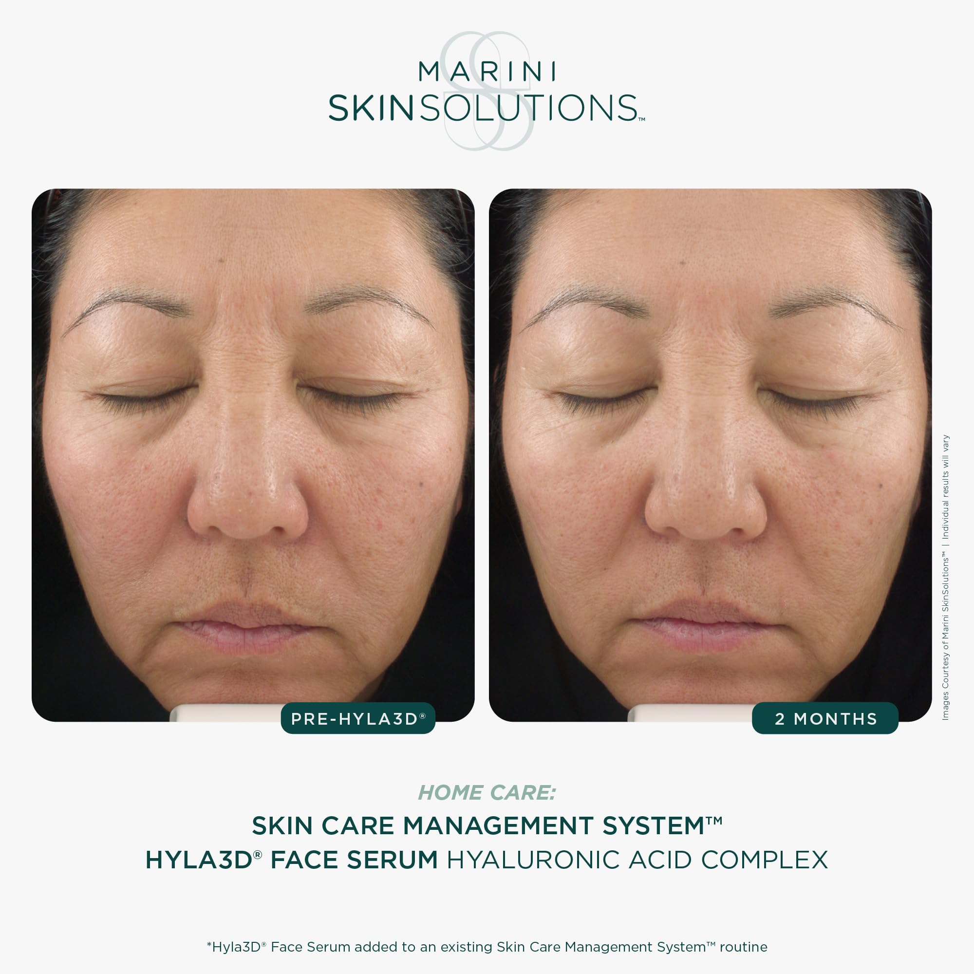 Marini SkinSolutions Hyla3D serum ingredients highlight HA technologies