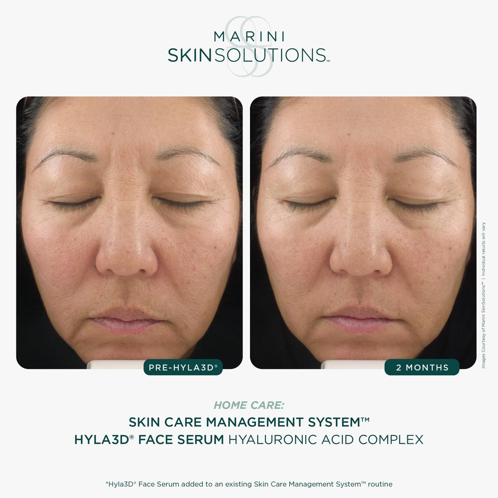 Marini SkinSolutions Hyla3D serum ingredients highlight HA technologies
