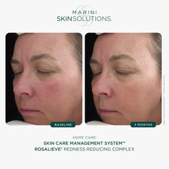 RosaLieve tetrapeptide-14 packaging focus suggests peptide support for skin comfort.