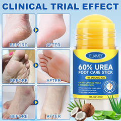 Mcukv callus-removal-stick delivers direct patch treatment.