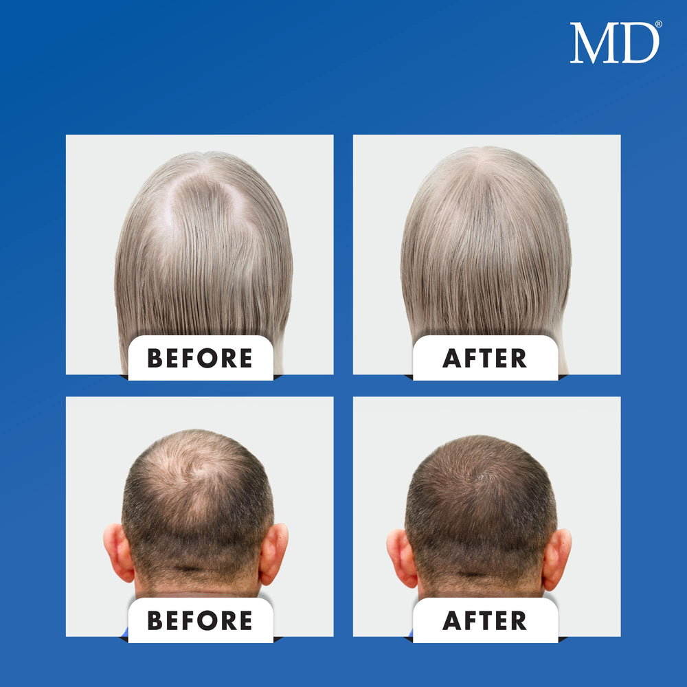 MD Nutri Hair capsules inside bottle convey consistent daily intake