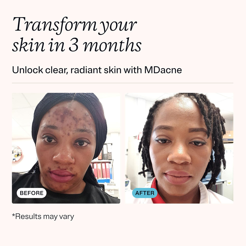 MDacne niacinamide moisturizer jar for oil-free hydration.