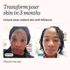 MDacne niacinamide moisturizer jar for oil-free hydration.
