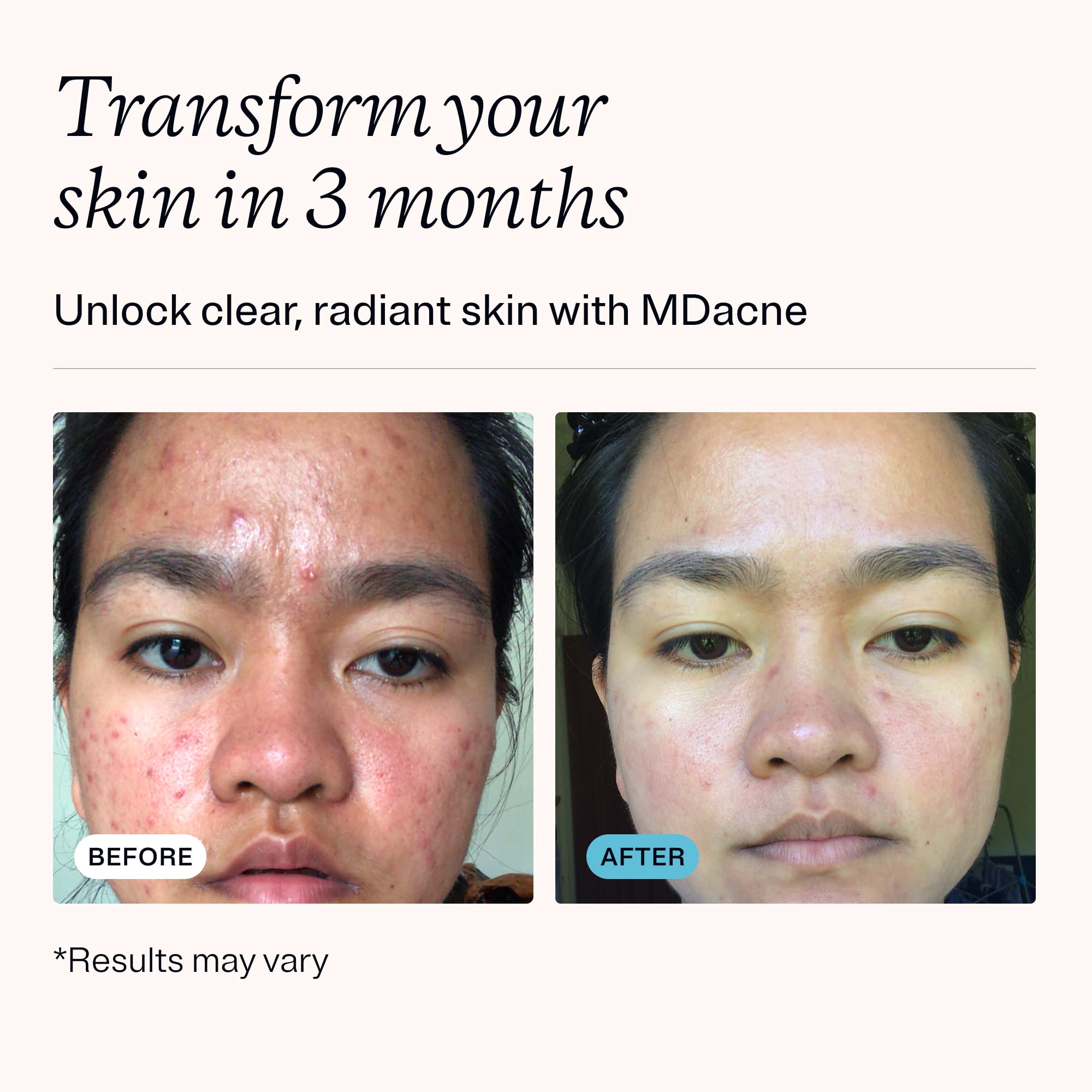 MDacne salicylic acid cleanser bottle ready to lift oil and debris.