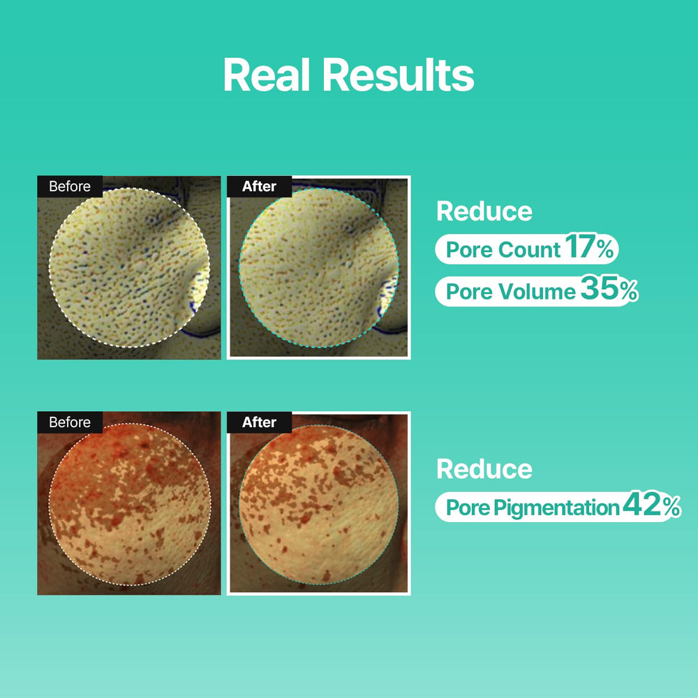 MEDITHERAPY Porethera close-up showing refined skin texture potential.