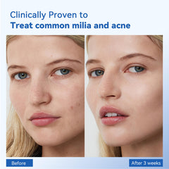 MEOLY Milia Remover on cheek area supports clearer skin around mid-face.