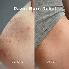Miami Beach Bum razor bump relief visual indicates calming aftercare possibilities.