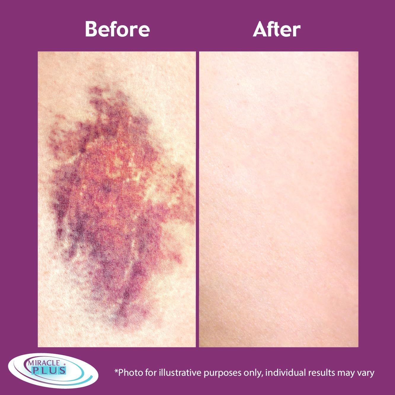 Miracle Plus Moisturizing bruising formula set packaging image