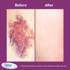 Miracle Plus Moisturizing bruising formula set packaging image