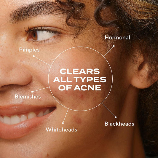 Murad Biome-Balancing Acne Serum close-up highlights texture-friendly, soothing skin benefits.