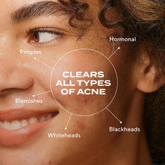 Murad Biome-Balancing Acne Serum close-up highlights texture-friendly, soothing skin benefits.