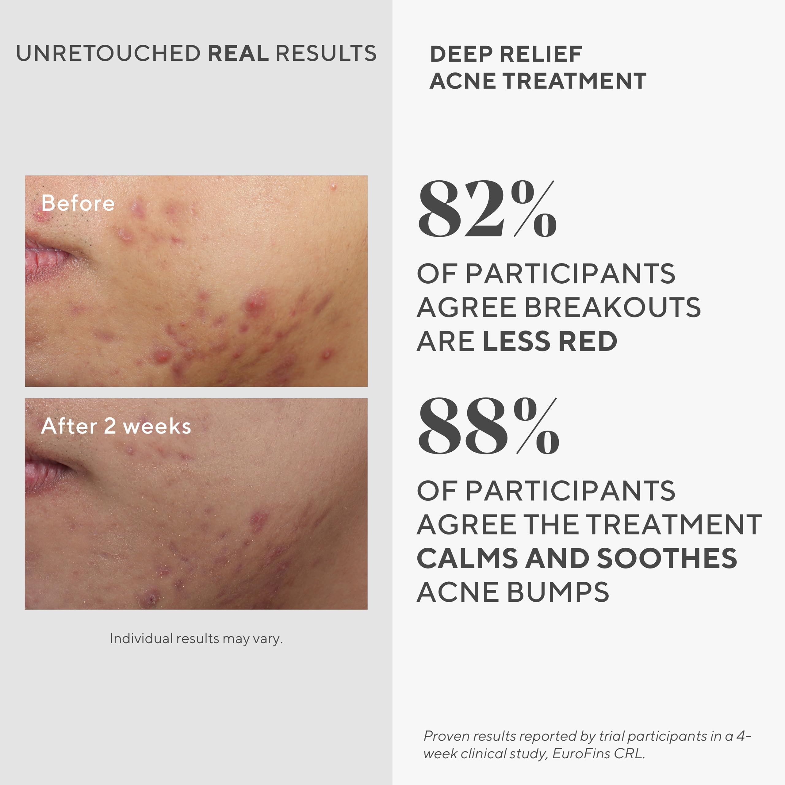 Murad Deep Relief spot-treatment application targets blemishes on skin.