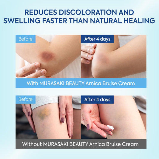 Murasaki Beauty Arnica Bruising Cream label showing key ingredients