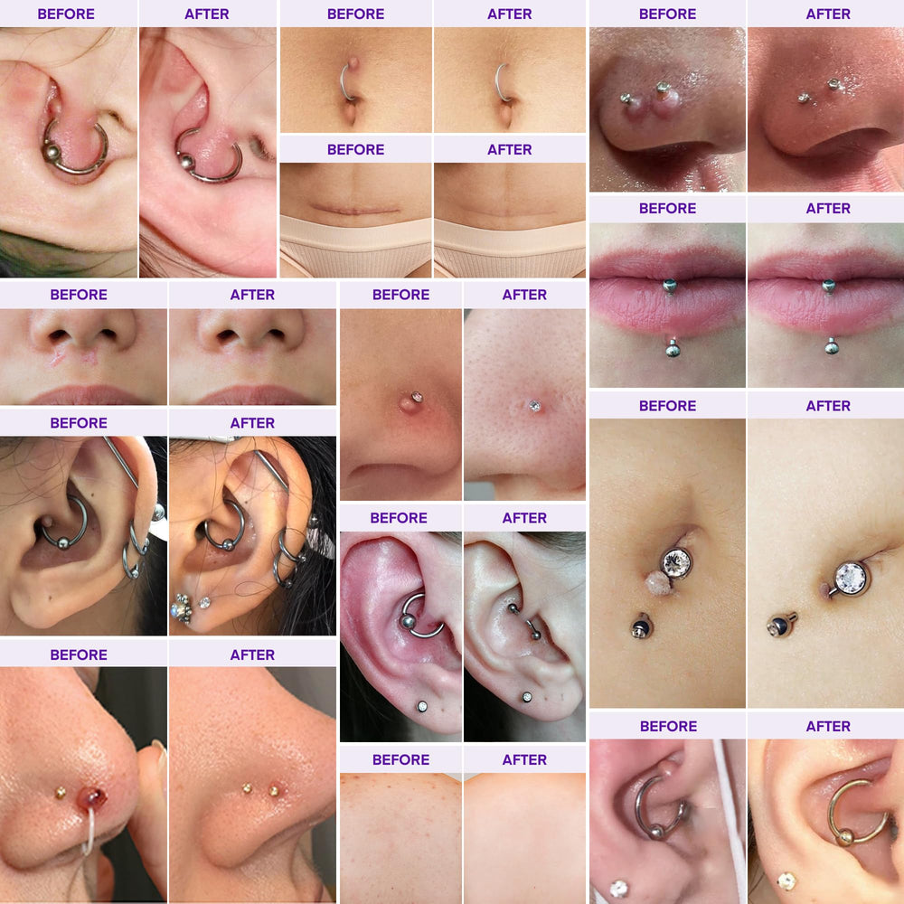 MURASAKI BEAUTY keloid gel tube closeup highlighting scar-smoothing action.