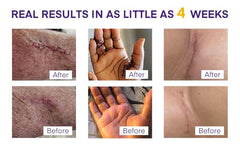 MURASAKI BEAUTY packaging for silicone scar gel.