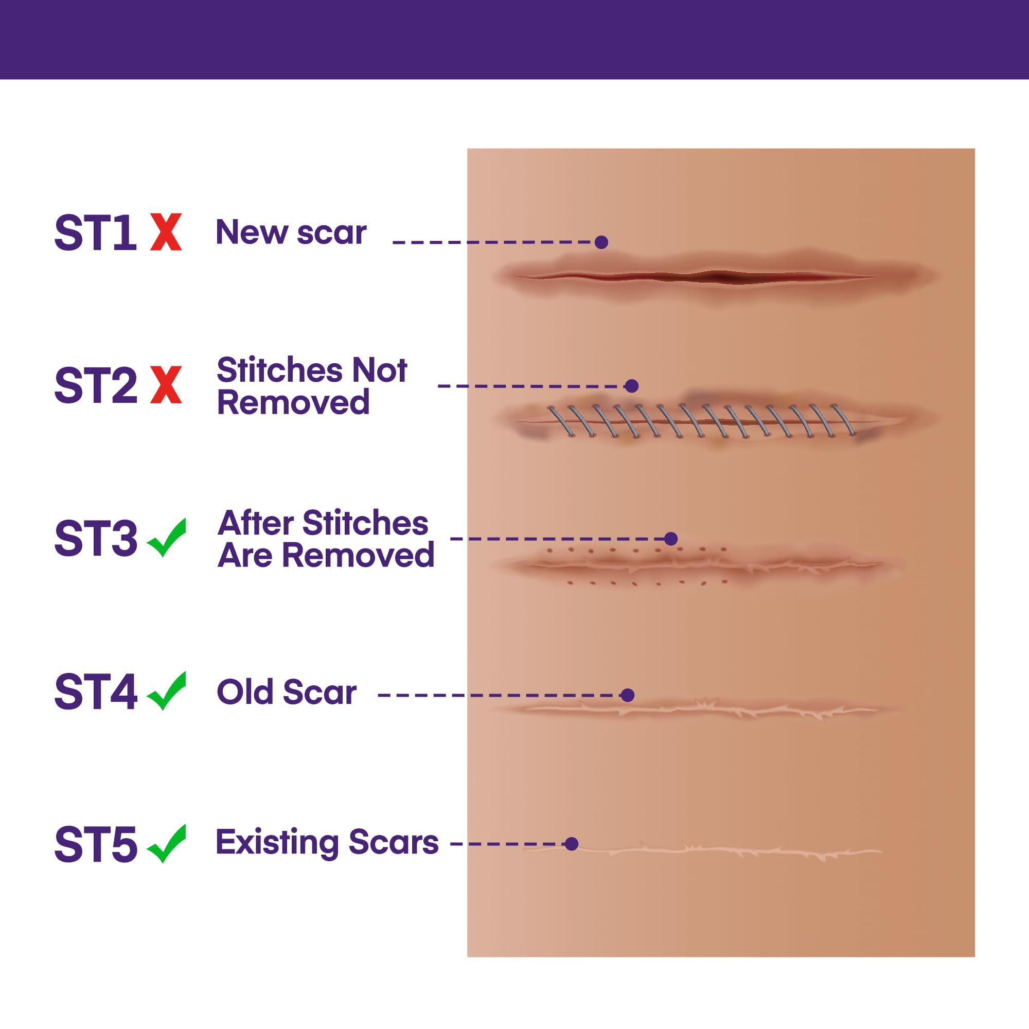 MURASAKI BEAUTY SPF 30 scar gel protects healing skin.