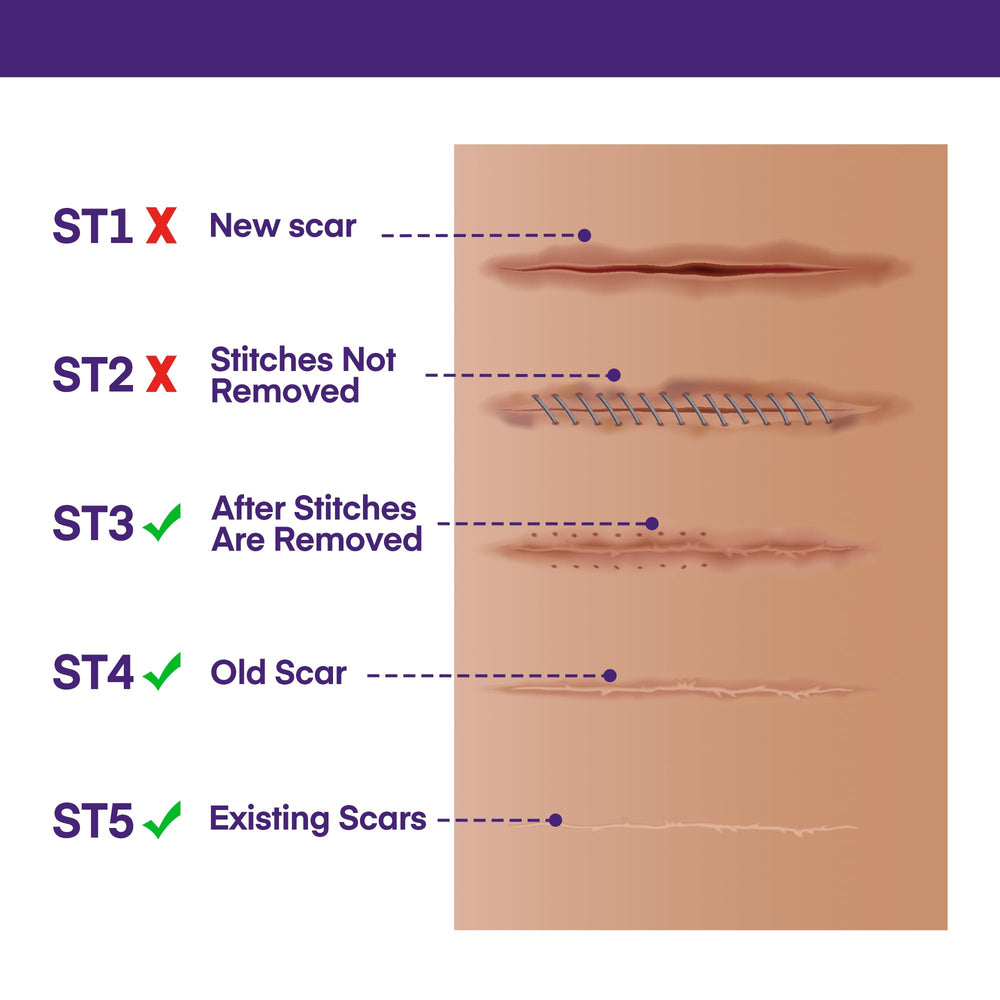 MURASAKI BEAUTY SPF 30 scar gel protects healing skin.