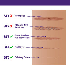MURASAKI BEAUTY SPF 30 scar gel protects healing skin.