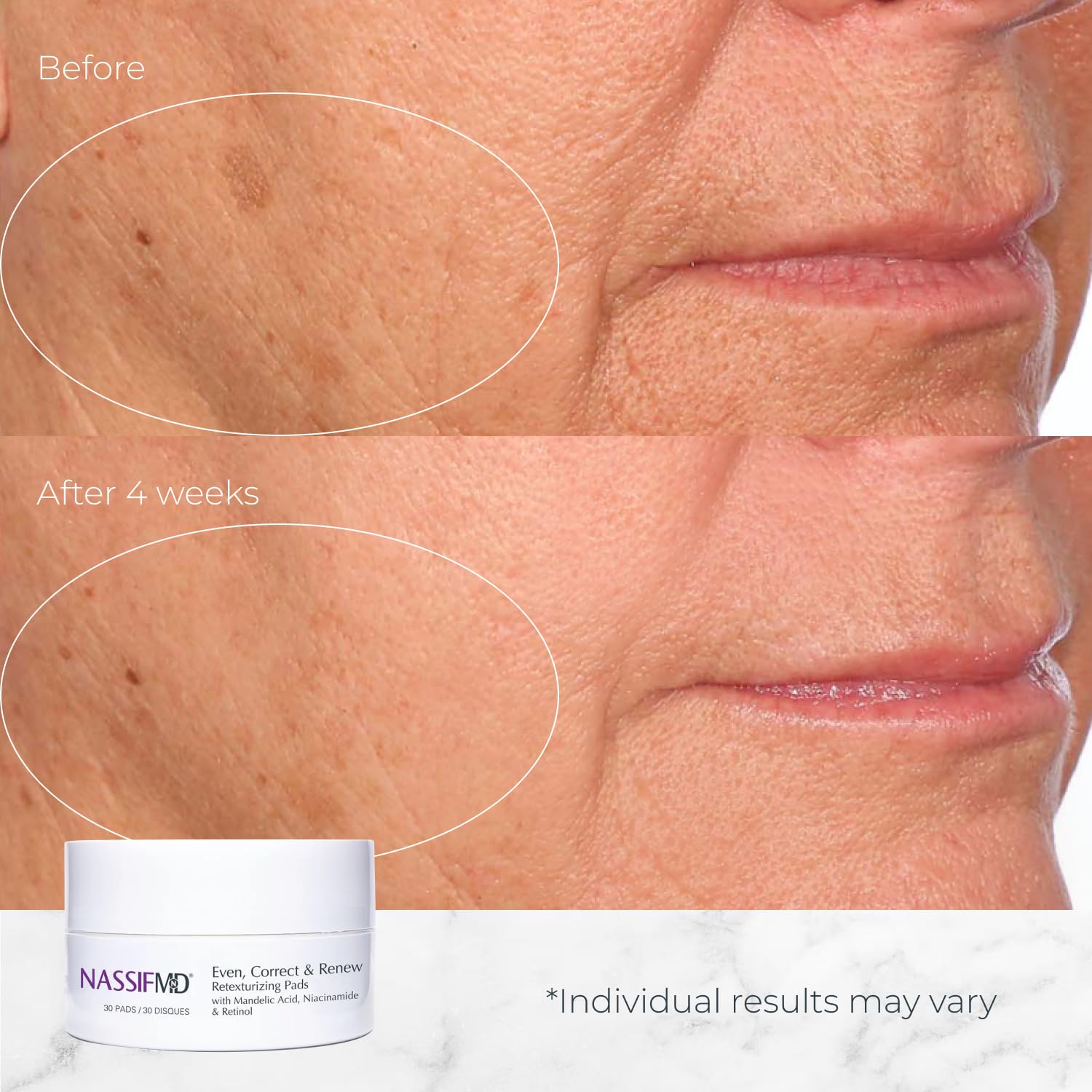 Travel-friendly NassifMD pads ideal for on-the-go skincare routines