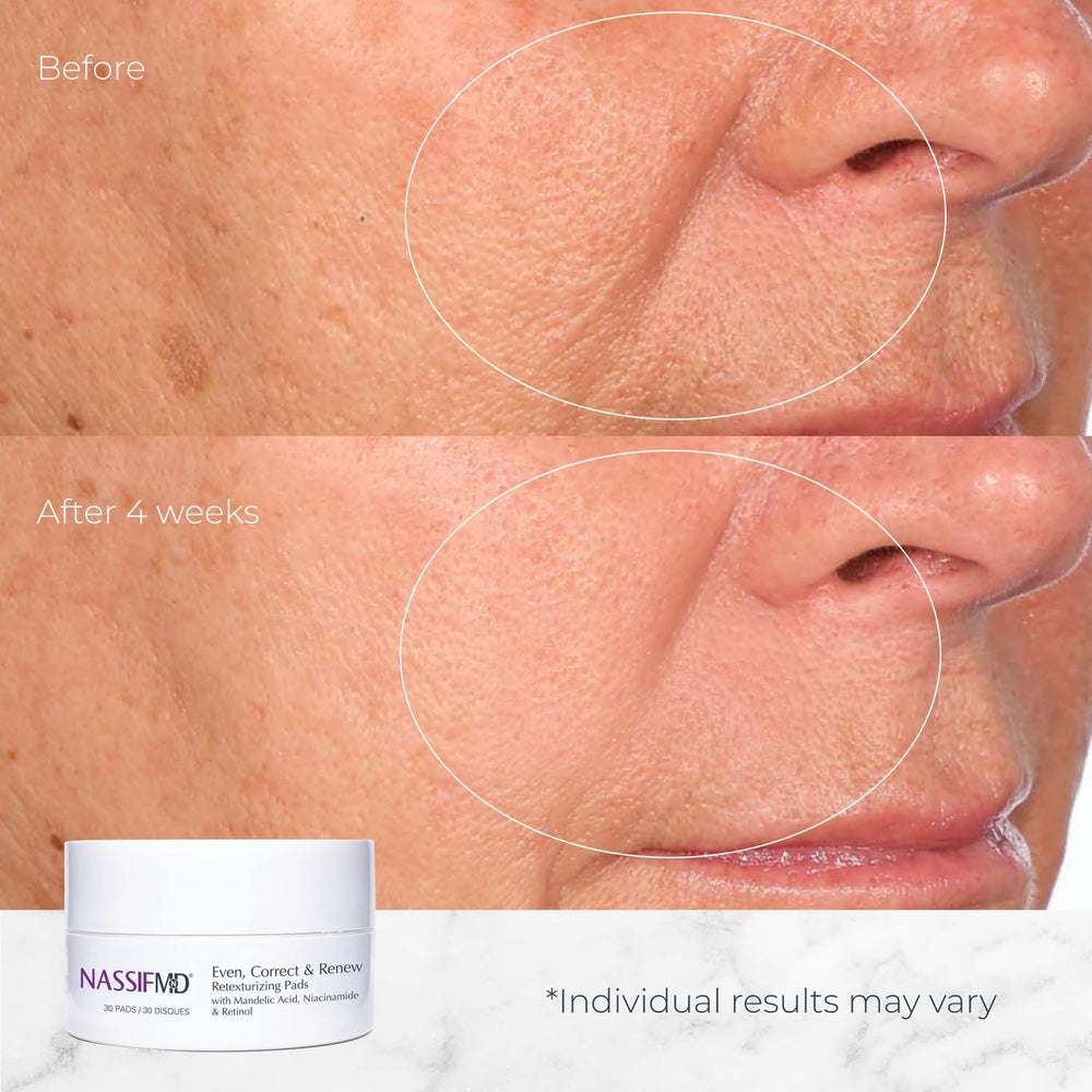 Hydration boost from hyaluronic acid in NassifMD pads during use