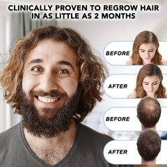 Nature Ziran Minoxidil 5% suitable for men and women use
