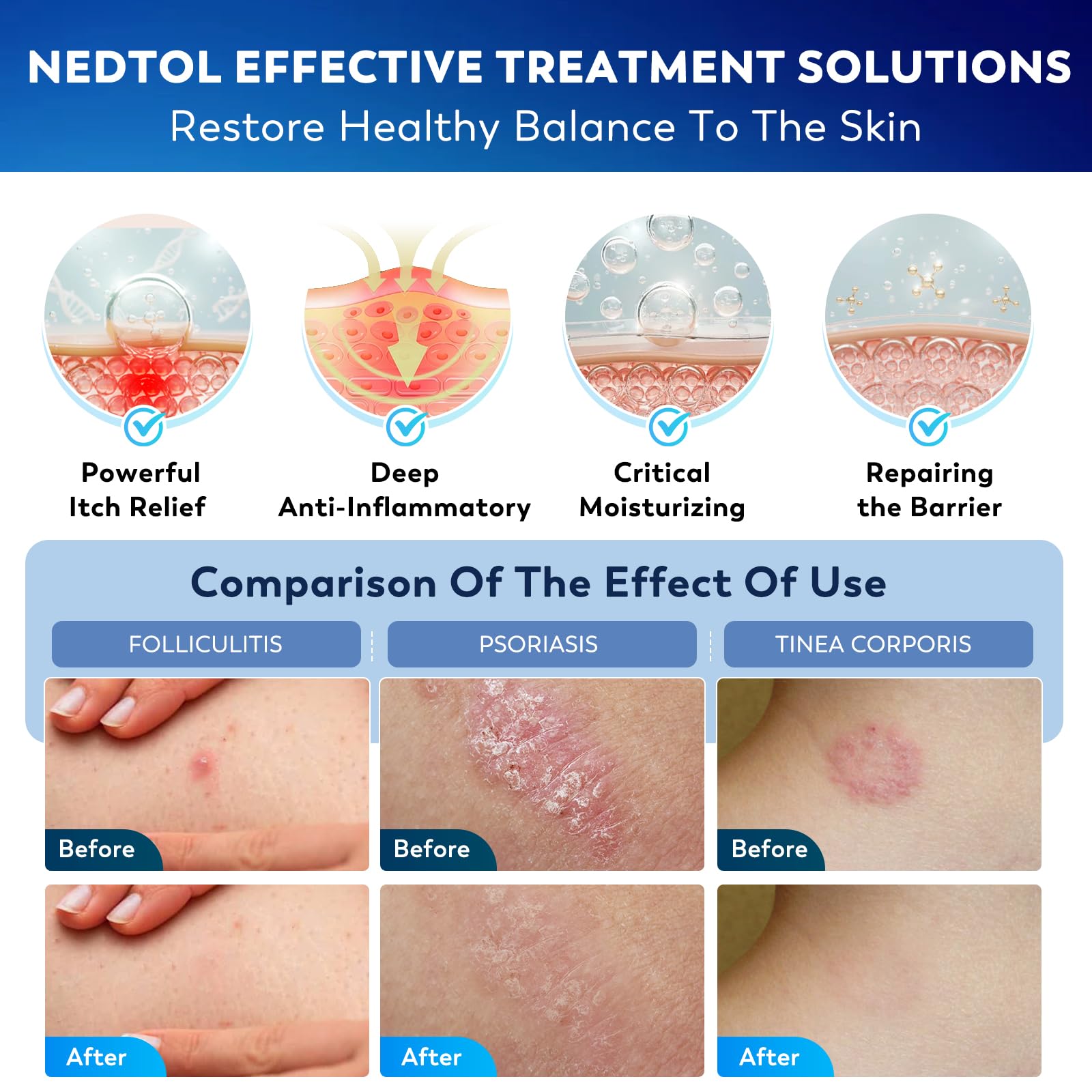 Nedtol Folliculitis Treatment Cream label closeup emphasizes herbal formula and steroid-free trust.