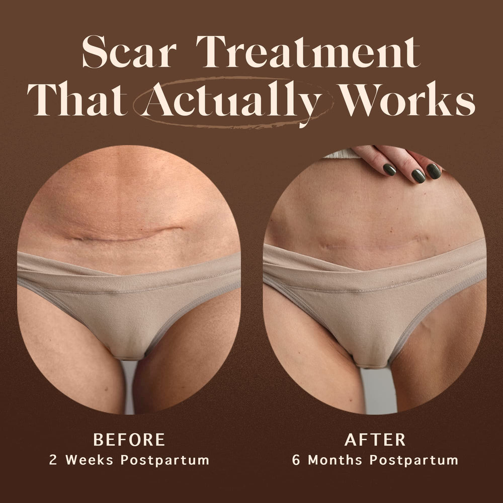Nemah c-section-scar-recovery application for gentle scar appearance support