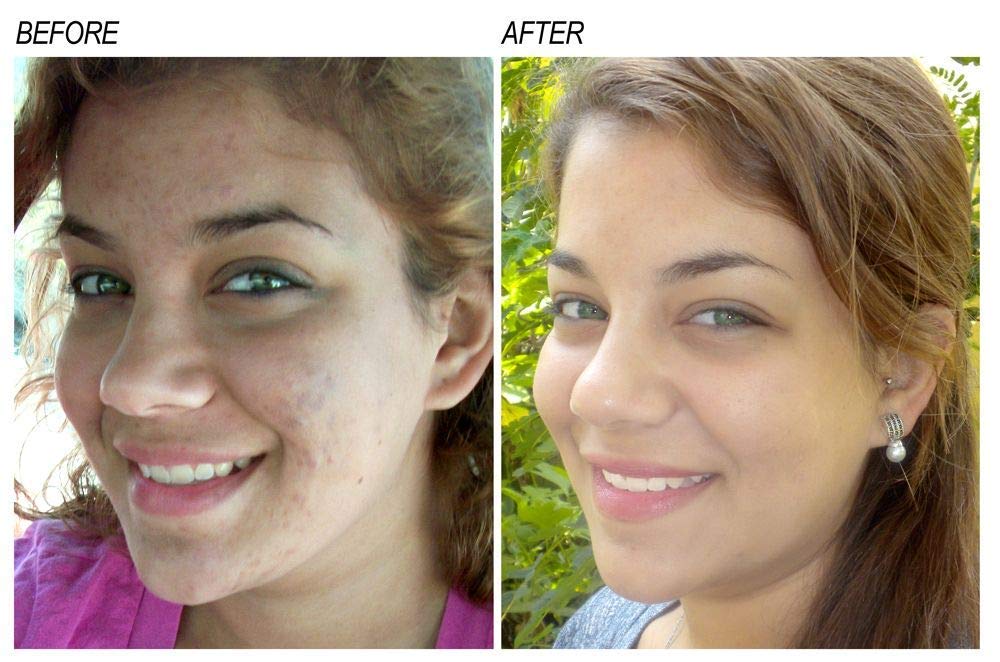 Neoprosone Vitamin C Serum drops application on skin for even tone