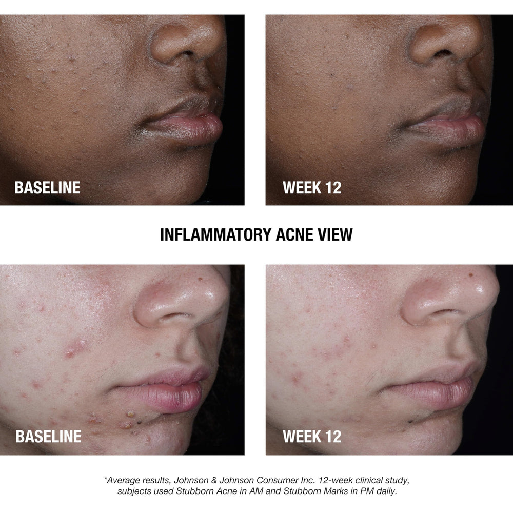 Neutrogena Stubborn Acne AM Treatment packaging box