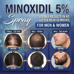 Nigwedete Minoxidil 5% spray bottle featuring Provitamin B5 for follicles.