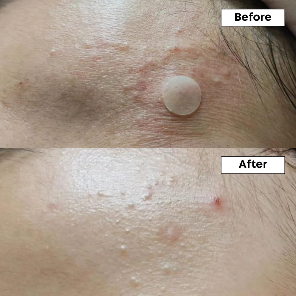 NINELESS A-Control ingredients-visual showcases active 10% azelaic acid and supporting components.