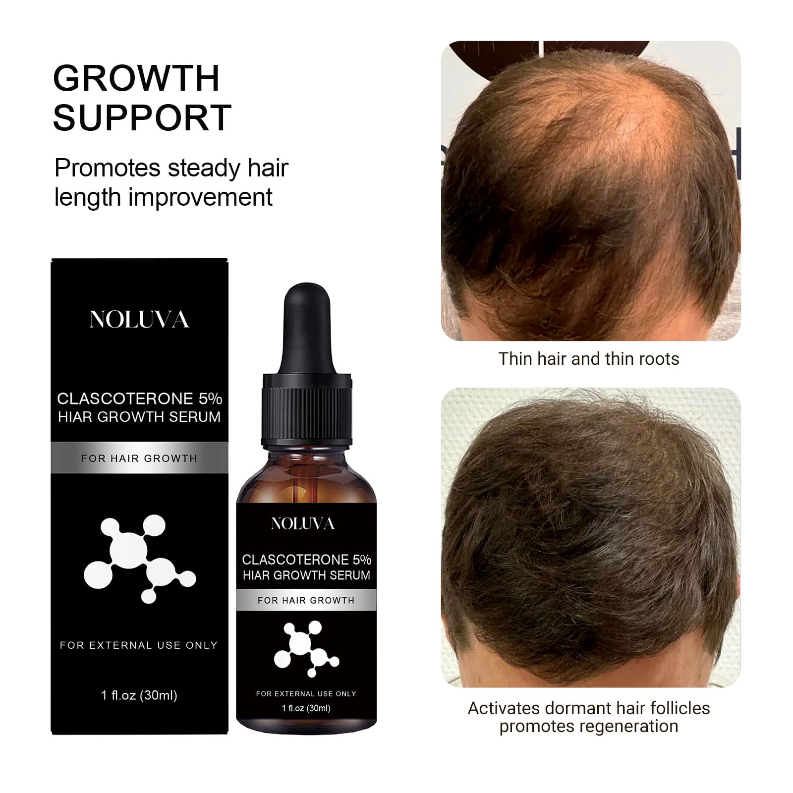 Clinical trial chart illustrating increased hair metrics with CLASCOTERONE 5%.