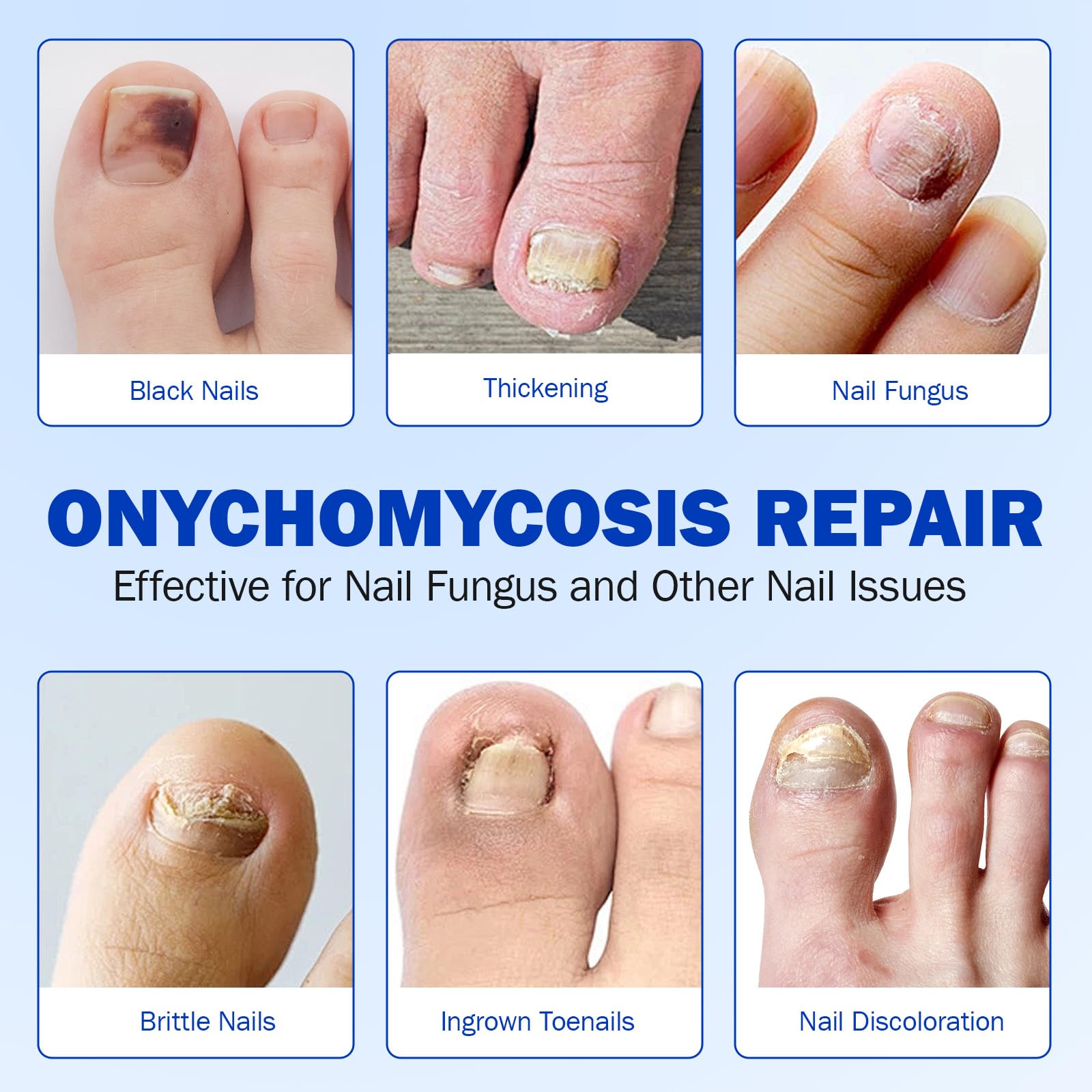 Nyloriaine patch demonstrates visible nail improvement over time.