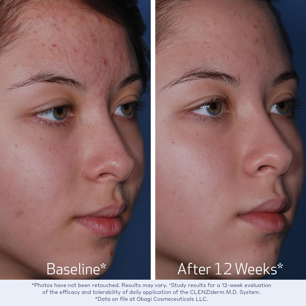 Obagi CLENZIderm MD acne lotion bottle with 5% BPO targets blemishes.
