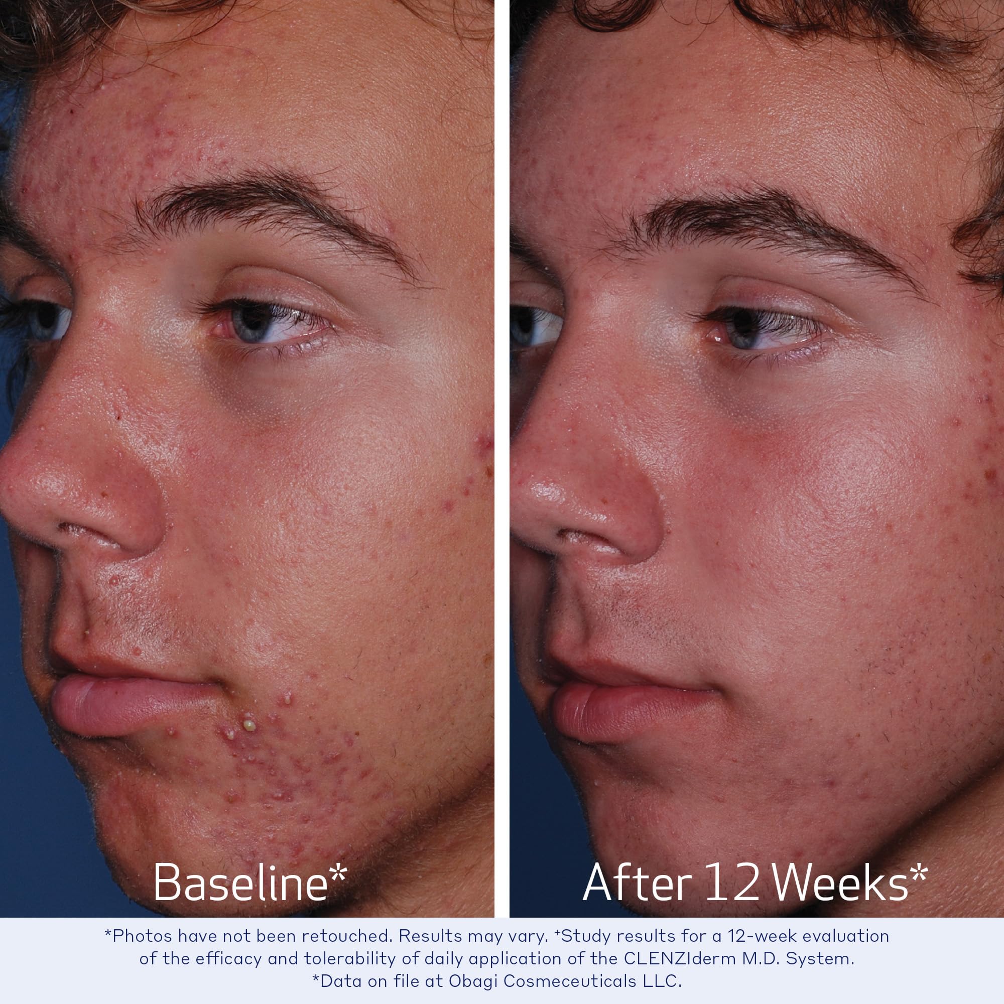 Obagi CLENZIderm MD packaging box showcases dermatologist-tested formulation.
