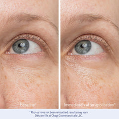 Puffiness around the eyes reduced by Obagi Daily Hydro-Drops Eye Gel Cream
