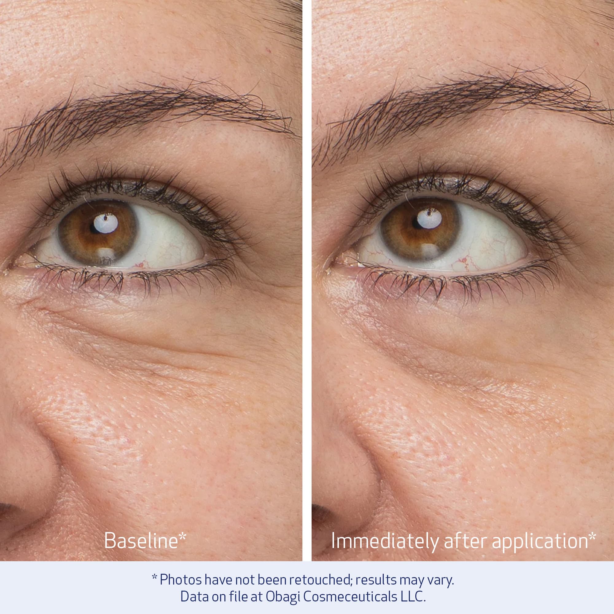 Under-eye area after applying Obagi Daily Hydro-Drops Eye Gel Cream