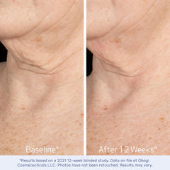 Retinoid smoothing action visual demonstrates texture improvement on the skin.