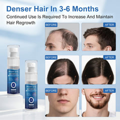 OCVWJKD Minoxidil spray on scalp being applied to thinning areas.