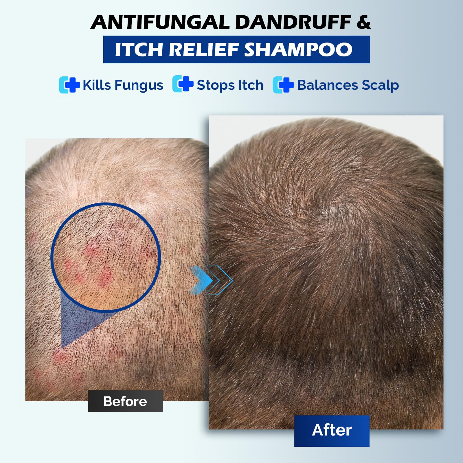 Oely anti-dandruff shampoo close-up shows flakes reduction and comfort