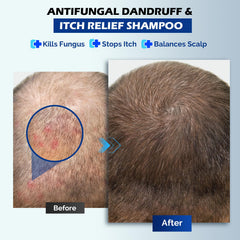 Oely anti-dandruff shampoo close-up shows flakes reduction and comfort
