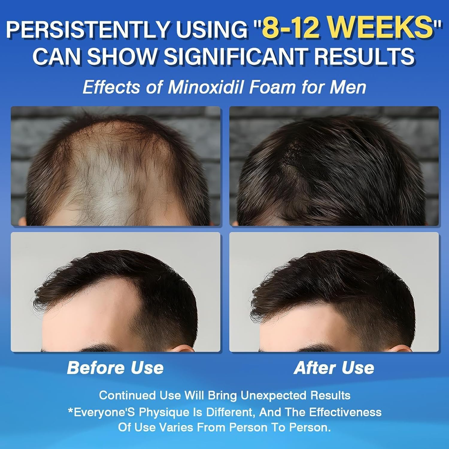 Olassubd Minoxidil 5% Foam dispensing action enables mess-free daily use.