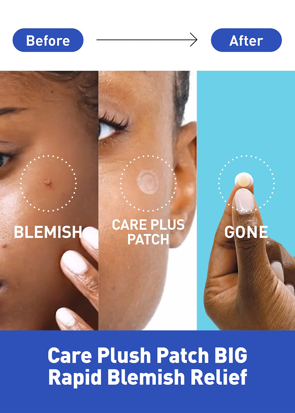 OLIVE YOUNG Care Plus Spot Patch Big on skin close-up shows discreet, thin coverage.