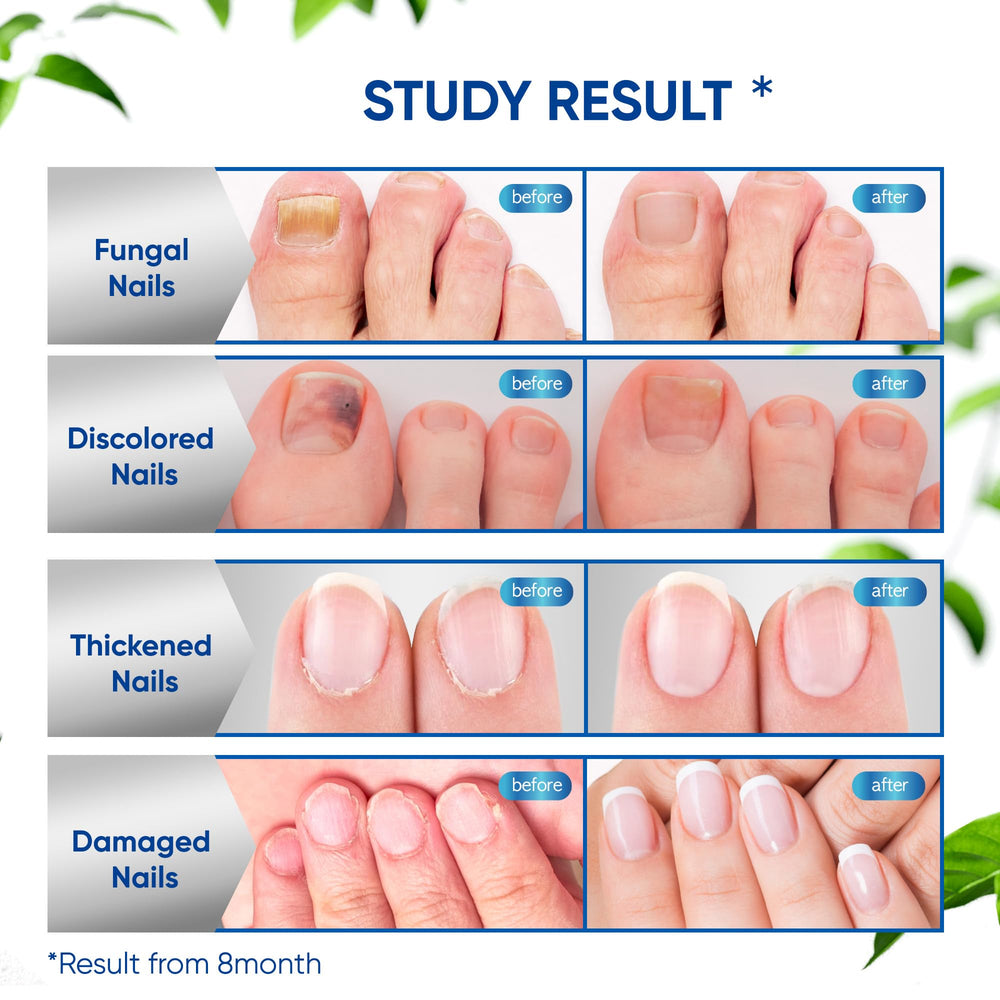 OSIMOON packaging highlights 10% undecylenic acid and natural oils