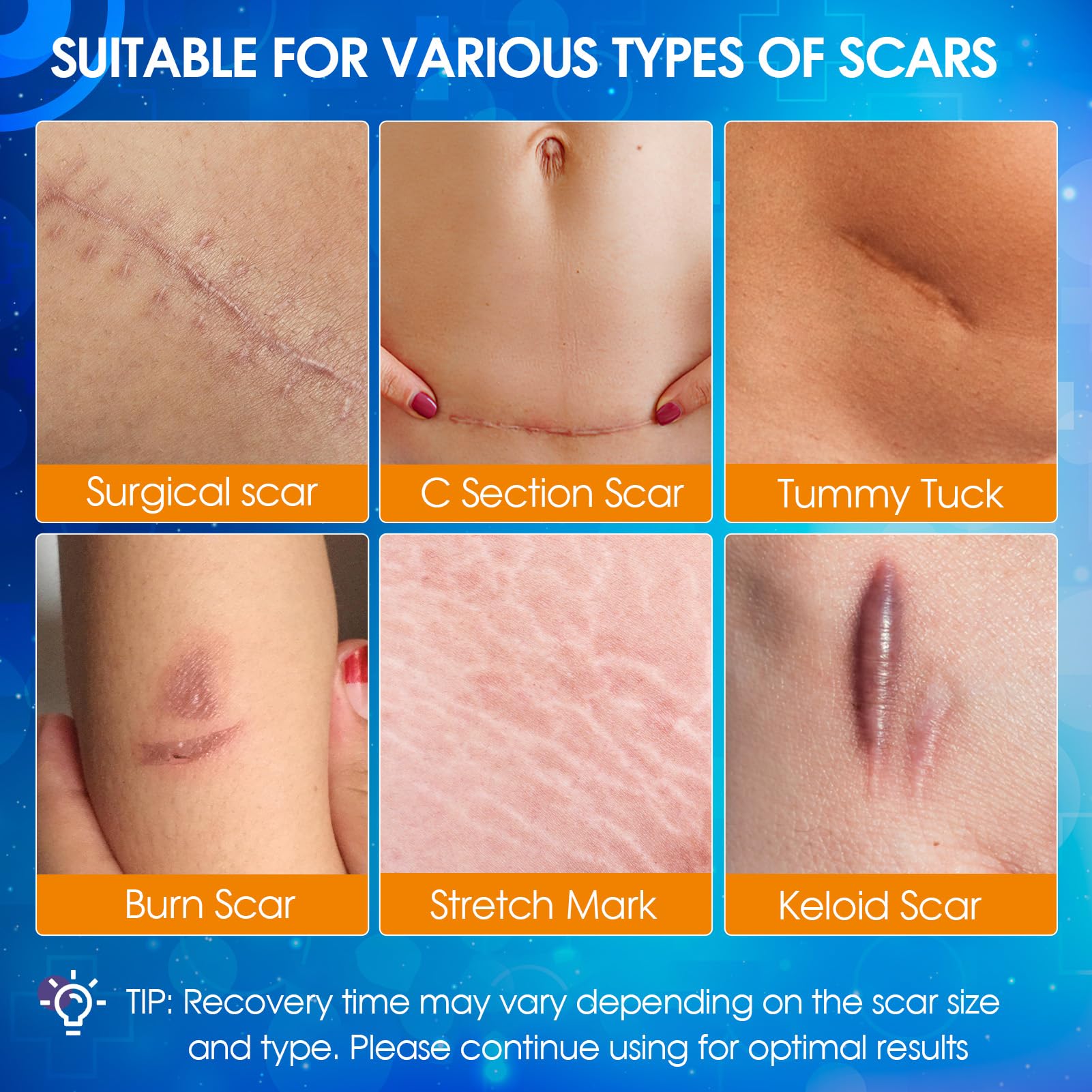 OUJEALEE soft-breathable silicone scar tape applied on skin for comfort.