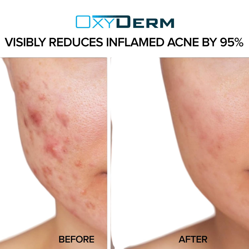 OxyDerm Acne Treatment Pads pore-clearing action helps reduce oil.