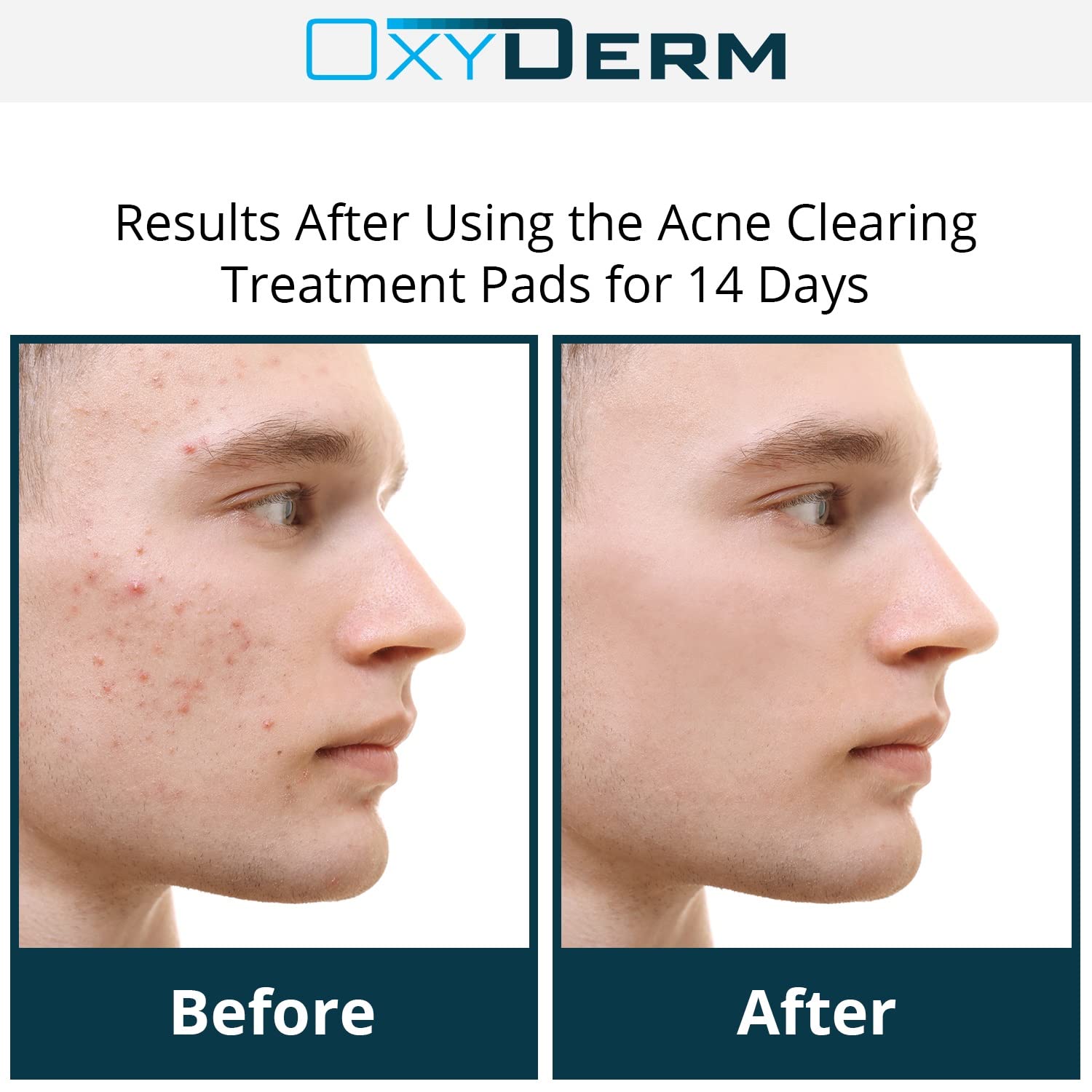 OxyDerm Acne Treatment Pads single pad closeup showing textured surface.
