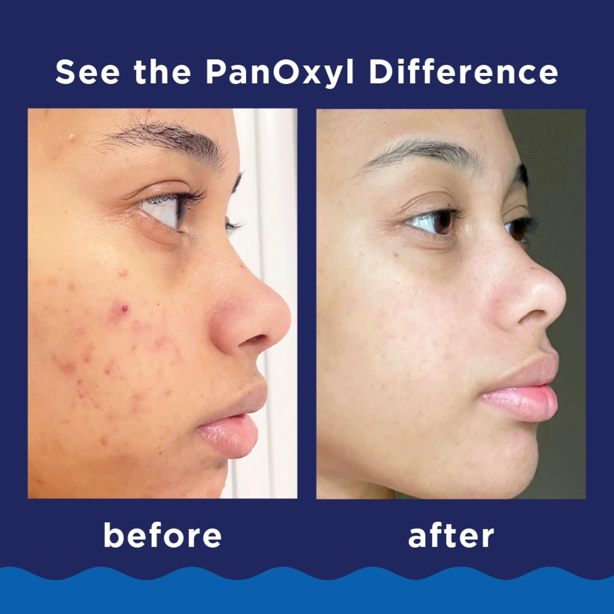 PanOxyl Foaming Acne Wash with step-by-step usage guidance visual.