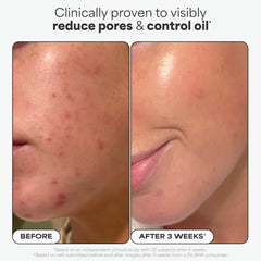 Pores before and after using Paula's Choice Exfoliant